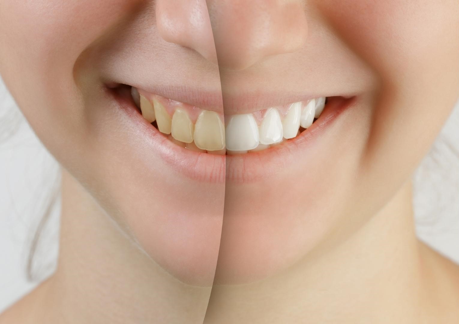 A before and after image of a woman who underwent teeth whitening treatment