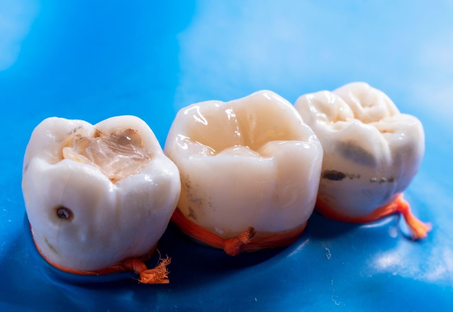 image of composite fillings