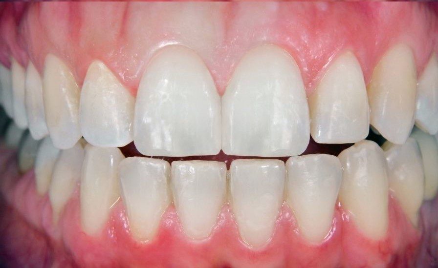 Dental Crown After