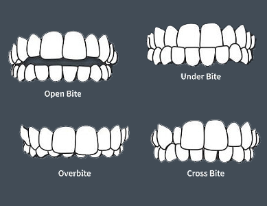 Bite Misalingment