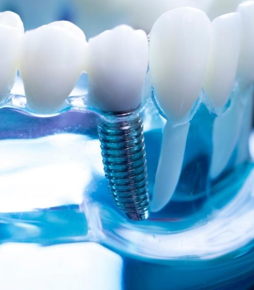 Clinical photo of dental implants