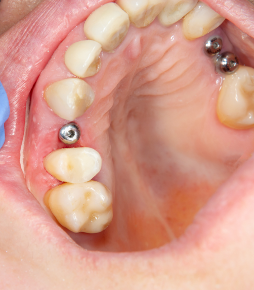 Example of Dental Implants